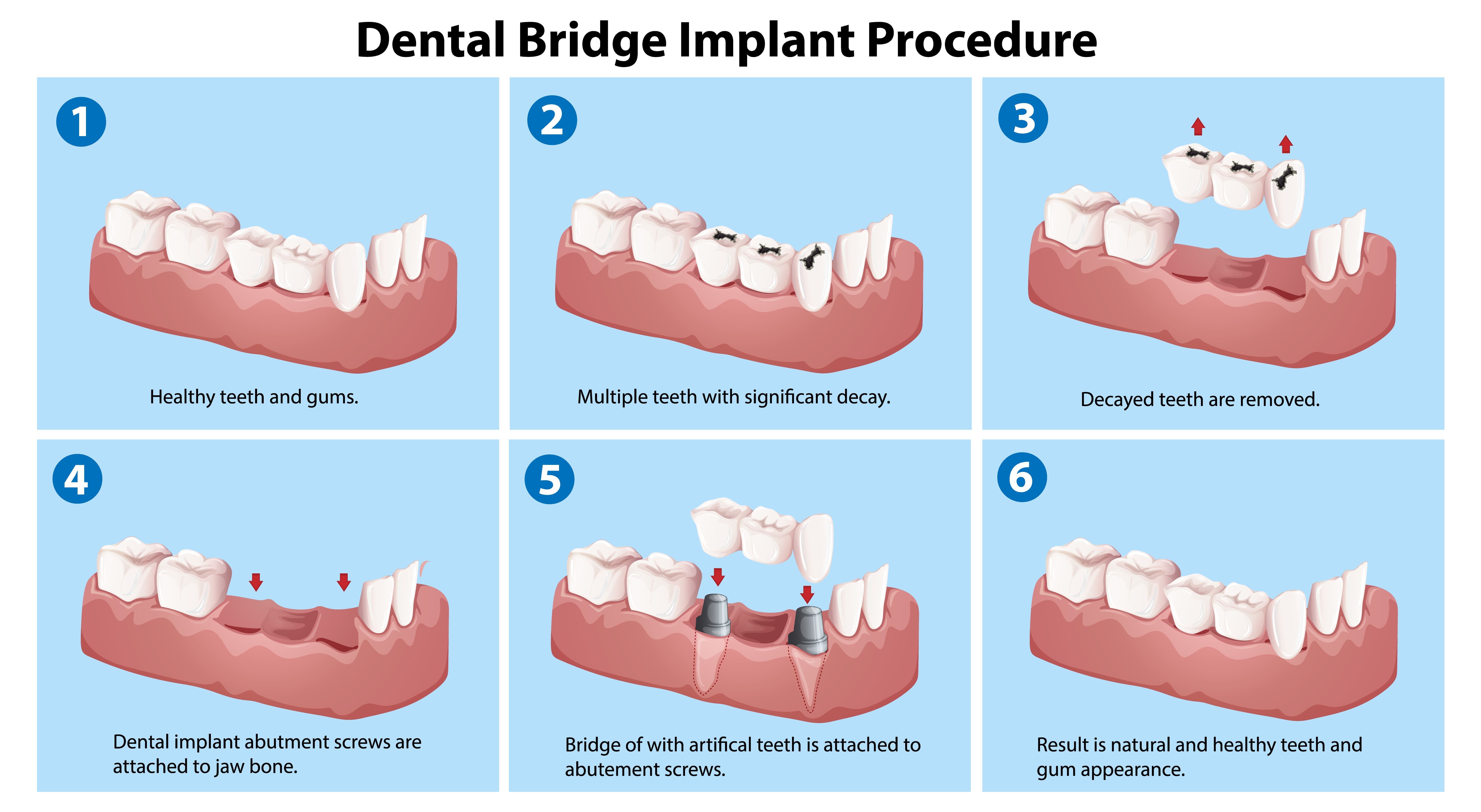 Имплантация зубов мостовидные протезы